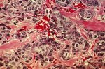 U.S. study will test whether drug combinations can wipe out tumors