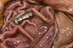 Innovative Vibrating Pill Signals Potential Breakthrough in Weight Loss