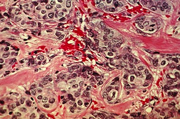 U.S. study will test whether drug combinations can wipe out tumors