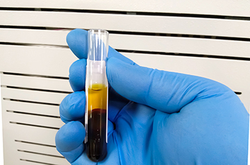 Can ‘toxic’ bilirubin treat a variety of illnesses?