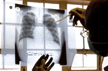 Major funders back pivotal trial of novel TB vaccine
