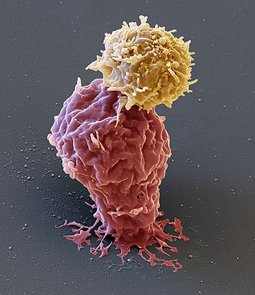FDA Investigates Potential Link Between CAR-T Therapy and Blood Cancer: What We Know So Far
