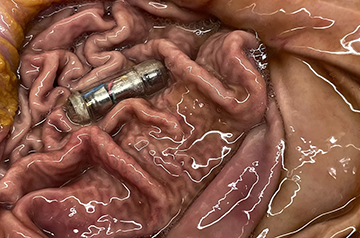 Innovative Vibrating Pill Signals Potential Breakthrough in Weight Loss