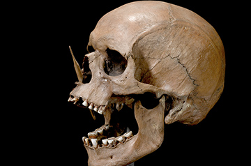Ancient DNA Unravels Mysteries: Higher Risk of Diseases, Including MS, Linked to Ancestry from Bronze Age Migrations