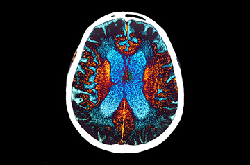 Study Suggests Alzheimer's Transmission through Historic Hormone Treatment