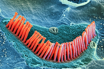 Gene Therapies Show Promise in Restoring Hearing for Deaf Children