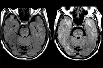 Preprint on Alzheimer’s drug deaths ignites dispute among authors