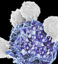 Personalized vaccine for melanoma may stave off cancer’s return