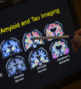 ‘It’s not a miracle drug’: Eli Lilly’s antibody slows Alzheimer’s disease but safety issues linger
