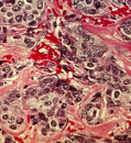U.S. study will test whether drug combinations can wipe out tumors