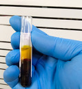 Can ‘toxic’ bilirubin treat a variety of illnesses?
