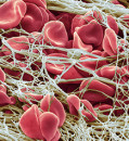 Clotting proteins linked to Long Covid’s brain fog