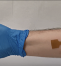 Programmable 3D printed wound dressing could improve treatment for burn, cancer patients
