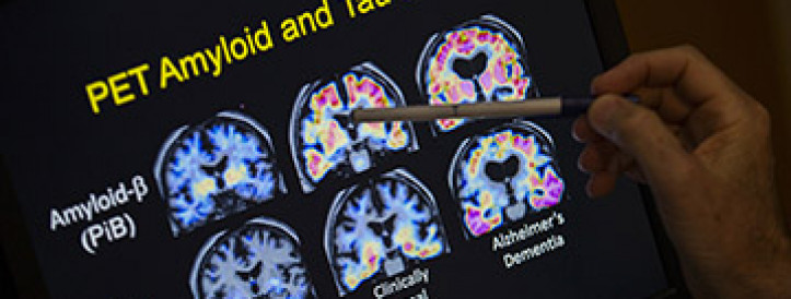 ‘It’s not a miracle drug’: Eli Lilly’s antibody slows Alzheimer’s disease but safety issues linger
