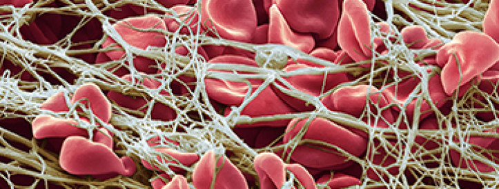 Clotting proteins linked to Long Covid’s brain fog