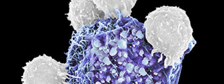 Personalized vaccine for melanoma may stave off cancer’s return