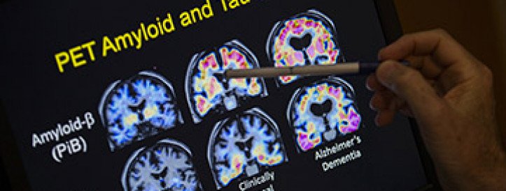 ‘It’s not a miracle drug’: Eli Lilly’s antibody slows Alzheimer’s disease but safety issues linger