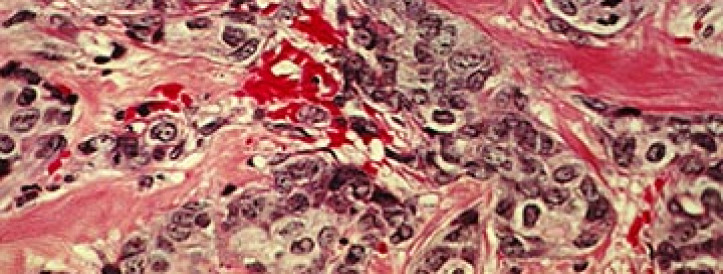 U.S. study will test whether drug combinations can wipe out tumors