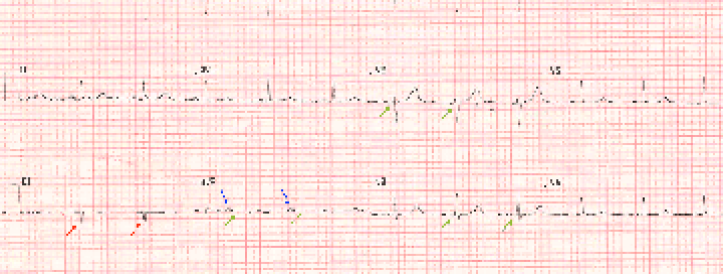 Dekaani ja arstitudengi Cureus paber tõmmati valesti märgistatud EKG tõttu tagasi
