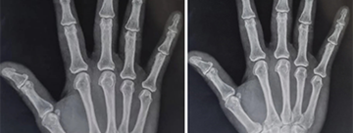 Teine artikkel, mis kirjeldab uut valusündroomi vaatluse all