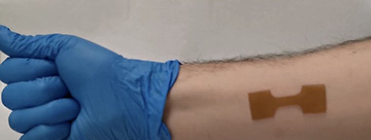 Programmable 3D printed wound dressing could improve treatment for burn, cancer patients